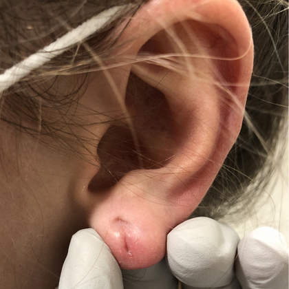 Split Earlobe Repair Case 10 - Before