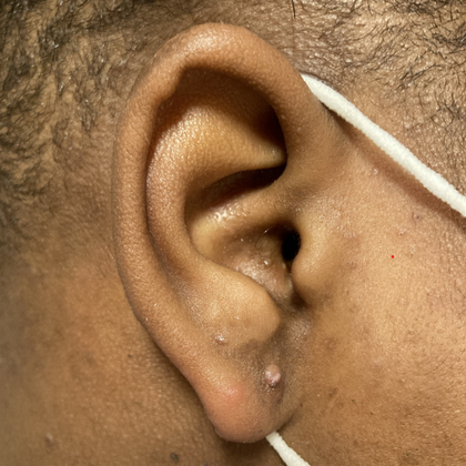 Keloid Earlobe Repair Case 1 - After