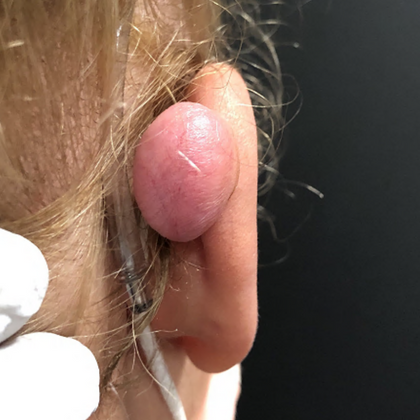 Keloid Earlobe Repair Case 2 - Before