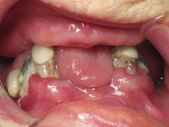Teeth in a Day: From Disaster to Smiles - Before