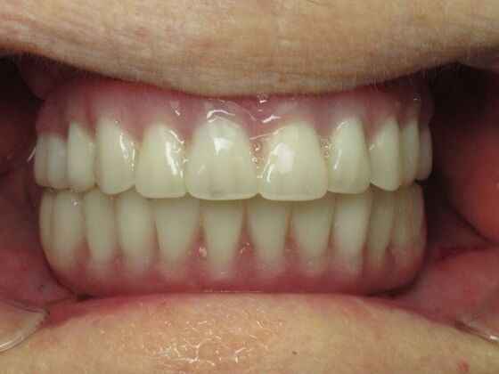 Teeth in a Day: From Disaster to Smiles - After