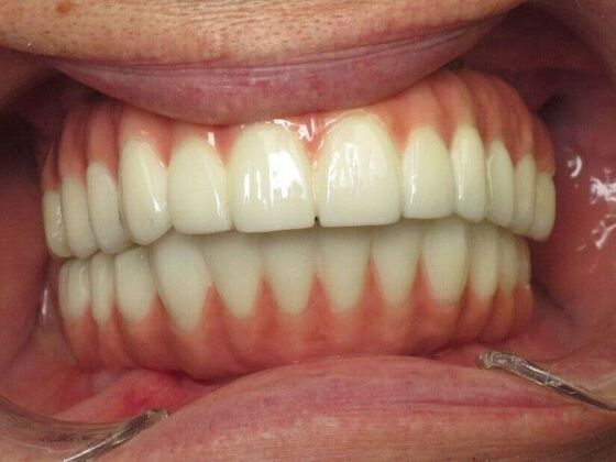 Teeth in a Day: Kathy