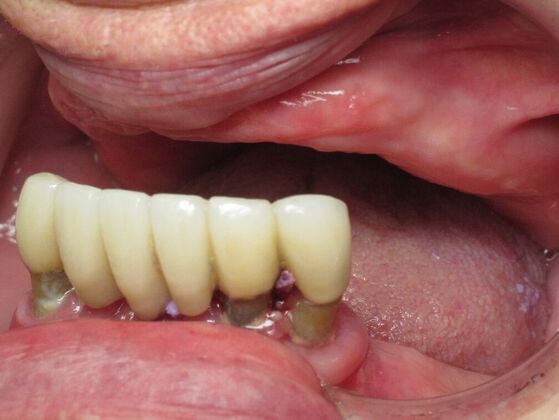 Teeth in a Day: Kathy