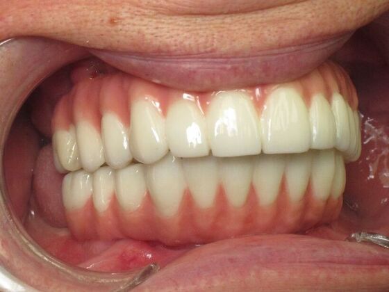 Teeth in a Day: Kathy