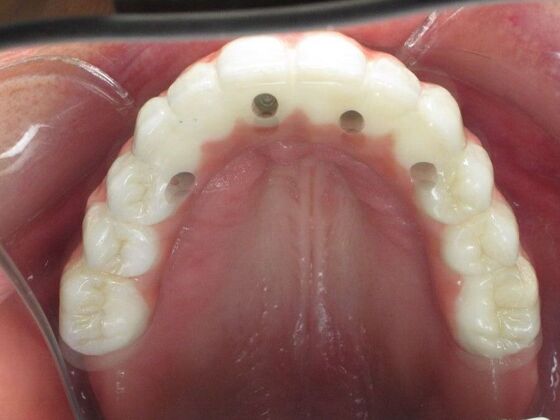 Teeth in a Day: Kathy