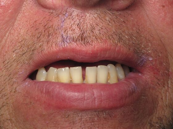 Teeth in a Day: Motivated to Quit Smoking and Move Forward With Fixed Teeth - Before