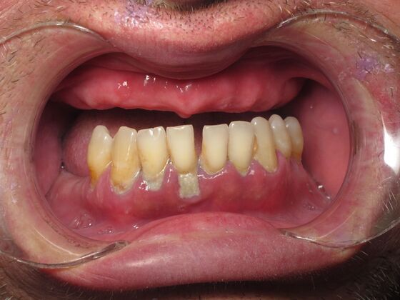 Teeth in a Day: Teeth Tomorrow - Before