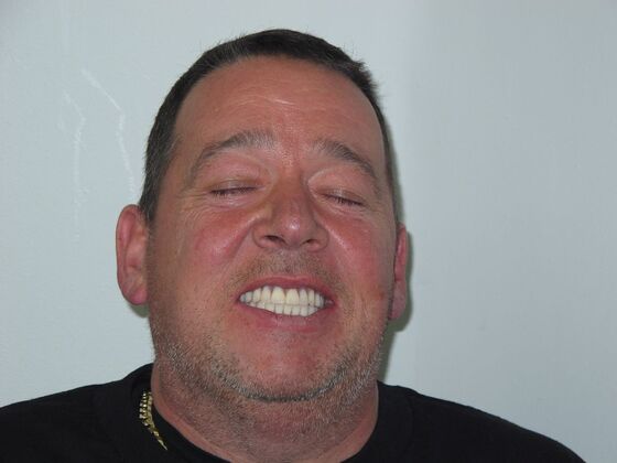 Teeth in a Day: Motivated to Quit Smoking and Move Forward With Fixed Teeth - After