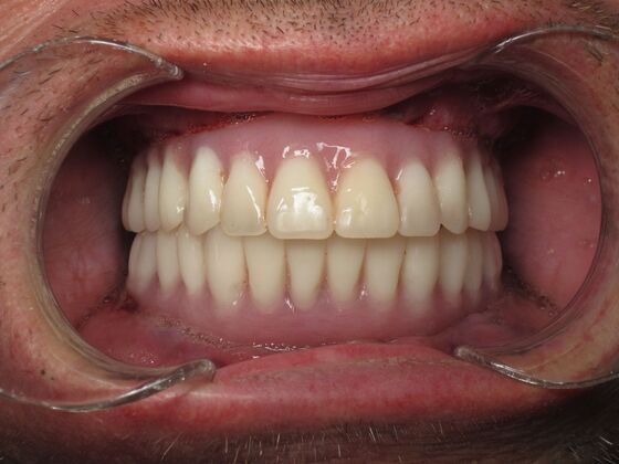 Teeth in a Day: Teeth Tomorrow - After