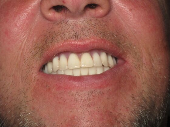 Teeth in a Day: Motivated to Quit Smoking and Move Forward With Fixed Teeth - After