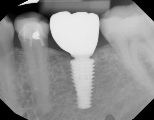 Dental Implants: Case 58 - Before