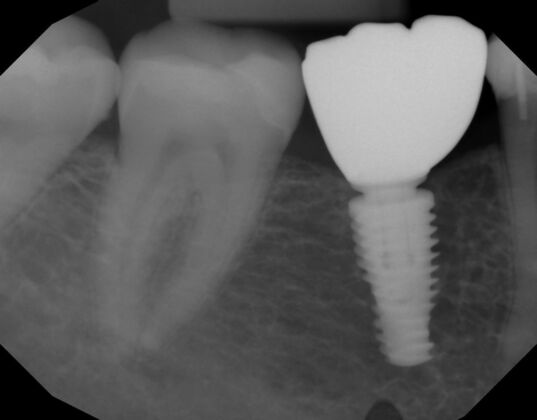 Dental Implants: Case 58 - After