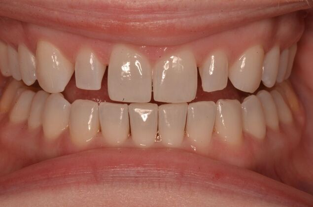 Composite Bonding: Case 8 - Before