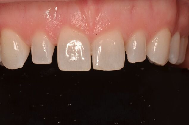 Composite Bonding: Case 8 - Before