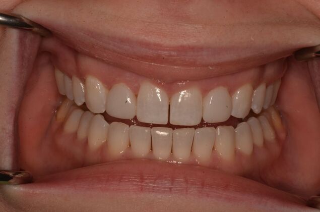 Composite Bonding: Case 8 - After