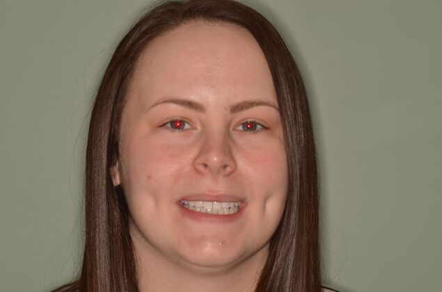 Composite Bonding: Case 8 - After