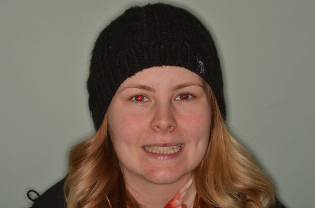 Composite Bonding: Case 8 - Before