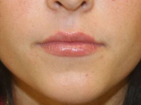 Injectables Case 8 - After