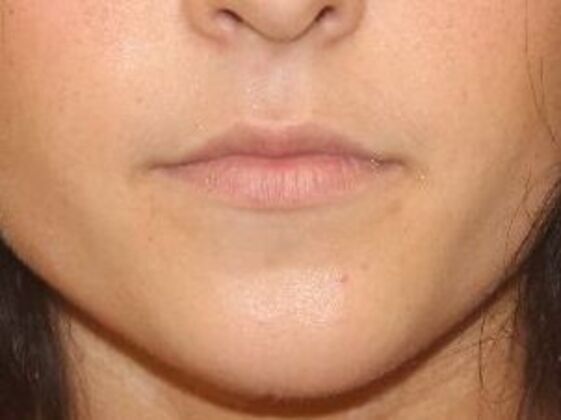 Injectables Case 8 - Before