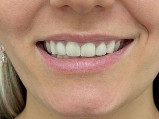 Injectables: Case 9 - Before