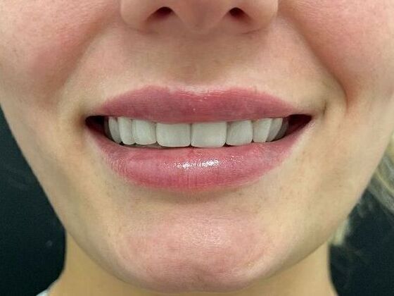 Injectables: Case 9 - After