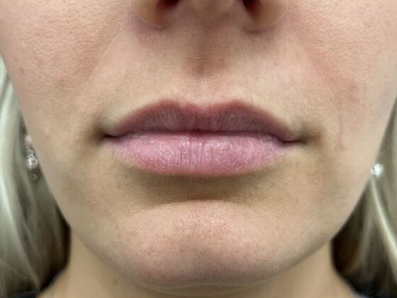 Injectables Case 9 - Before