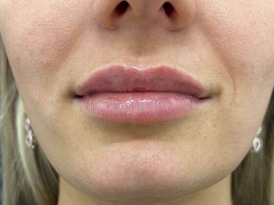 Injectables Case 9 - After