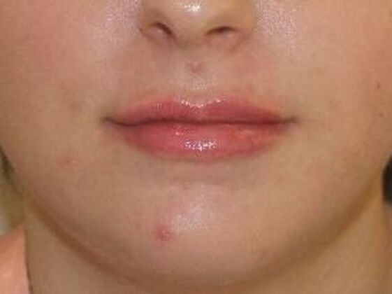 Injectables Case 10 - After