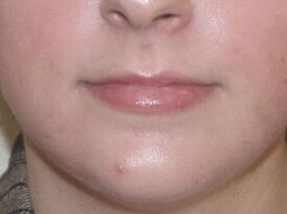 Injectables Case 10 - Before