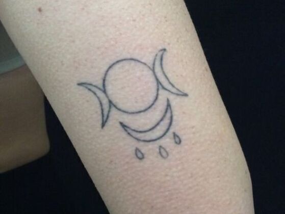 Laser Tattoo Removal Case 11 - Before