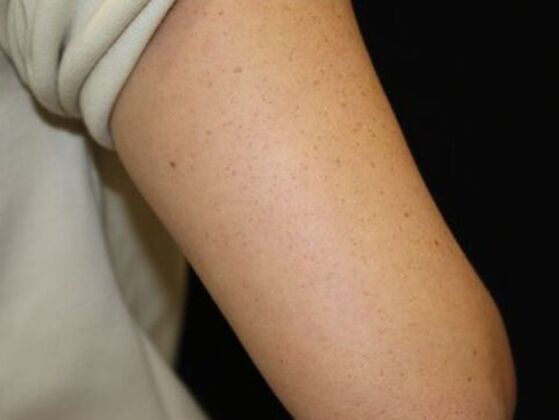 Laser Tattoo Removal Case 11 - After