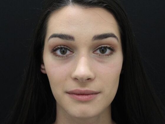 Injectables Case 11 - Before