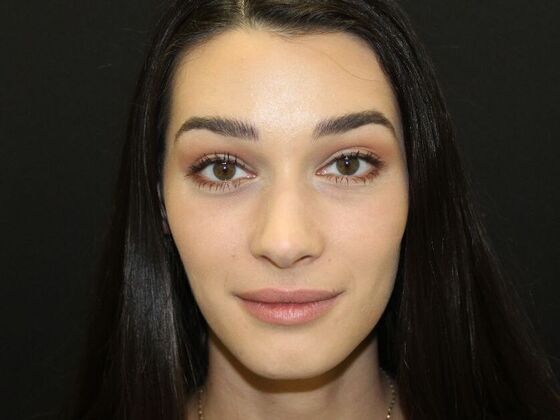 Injectables Case 11 - After