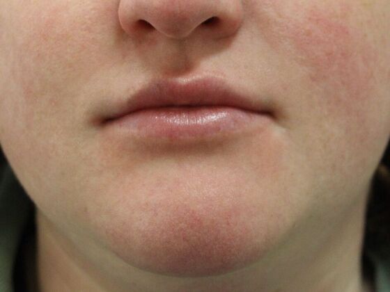 Injectables Case 12 - Before