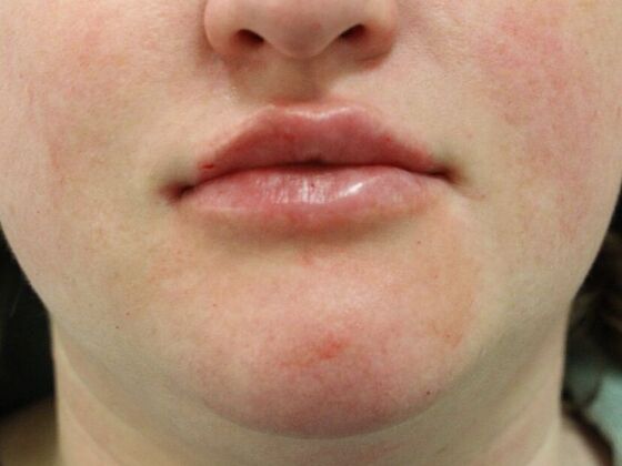 Injectables Case 12 - After