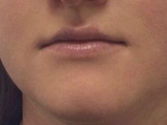 Injectables Case 13 - Before