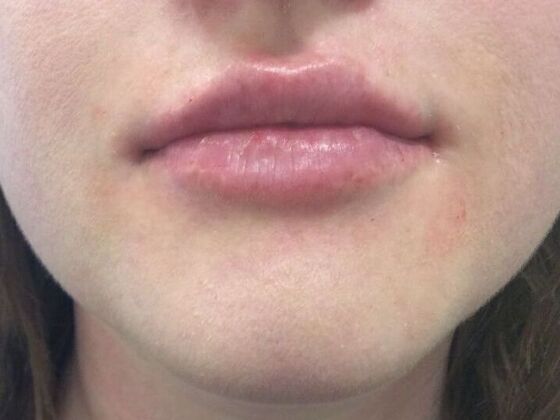 Injectables Case 13 - After