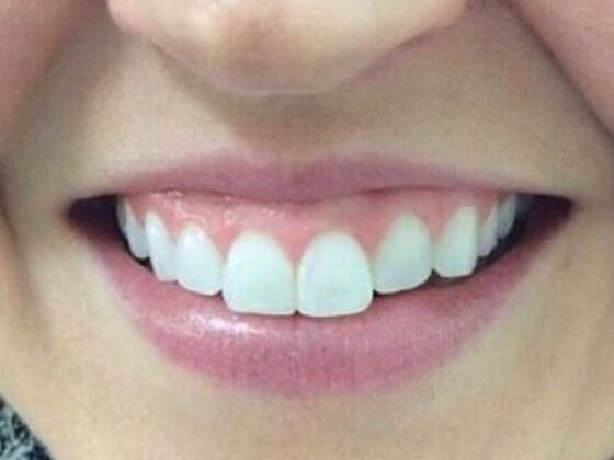 Injectables Case 14 - Before