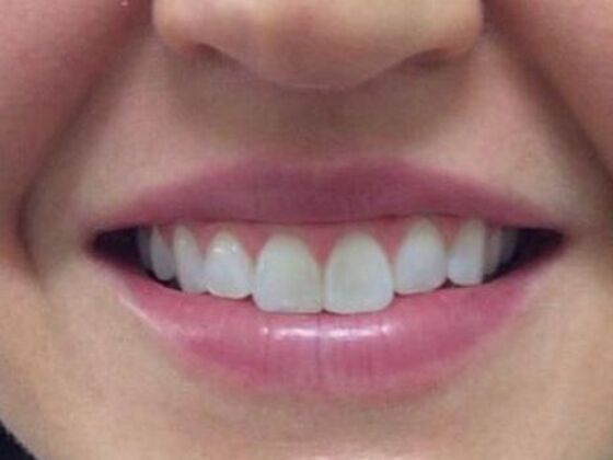 Injectables Case 14 - After