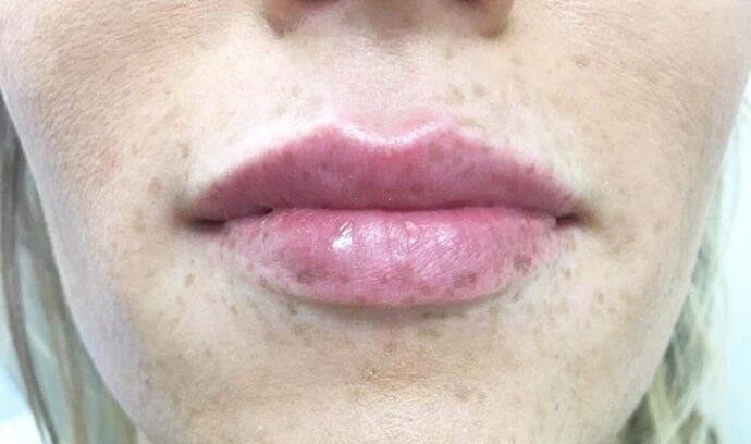 Injectables Case 15 - After