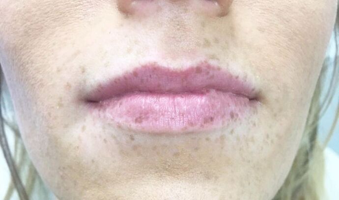 Injectables Case 15 - Before