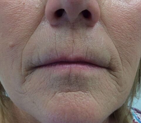 Injectables Case 16 - Before