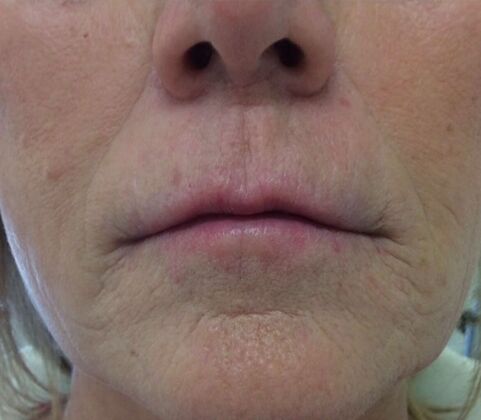 Injectables Case 16 - After