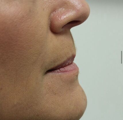 Injectables Case 17 - Before