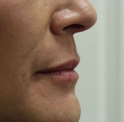 Injectables Case 17 - After