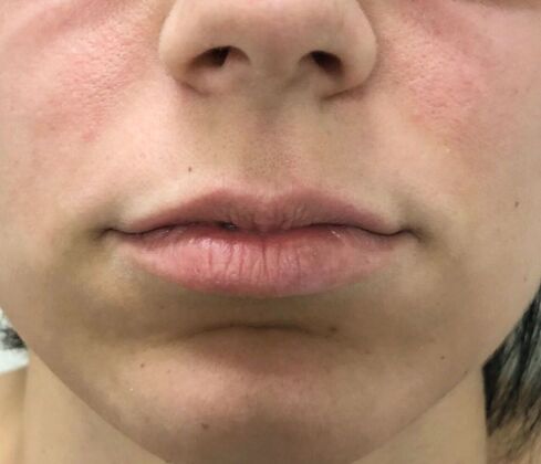 Injectables Case 18 - Before