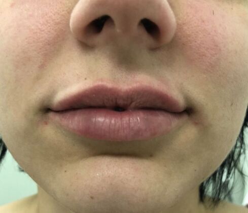 Injectables Case 18 - After