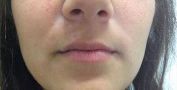 Injectables Case 19 - Before