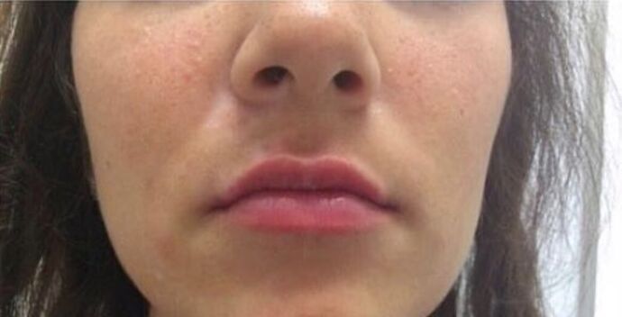 Injectables Case 19 - After