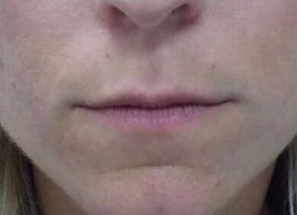 Injectables Case 20 - Before